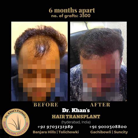 dr khan hair transplant